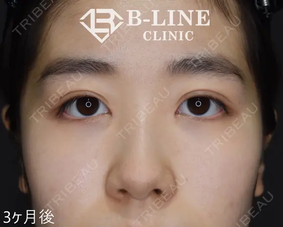 【二重全切開+目頭切開術(Z形成)】3ヶ月後 after画像 メイン用