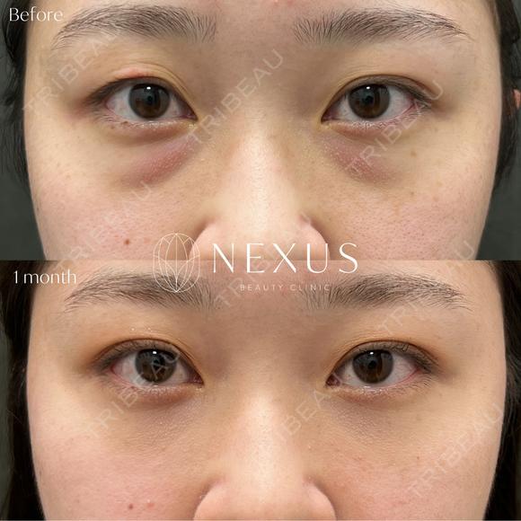 切らない目の下のたるみ取り＋脂肪注入 after画像 メイン用