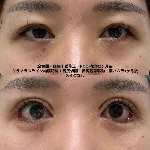 全切開＋眼瞼下垂修正＋グラマラスライン結膜切開＋目尻切開＋目尻靱帯移動＋裏ハムラ 30日後 メイン用