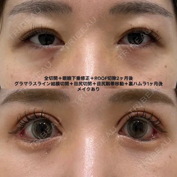 全切開＋眼瞼下垂修正＋グラマラスライン結膜切開＋目尻切開＋目尻靱帯移動＋裏ハムラ 30日後 メイン用