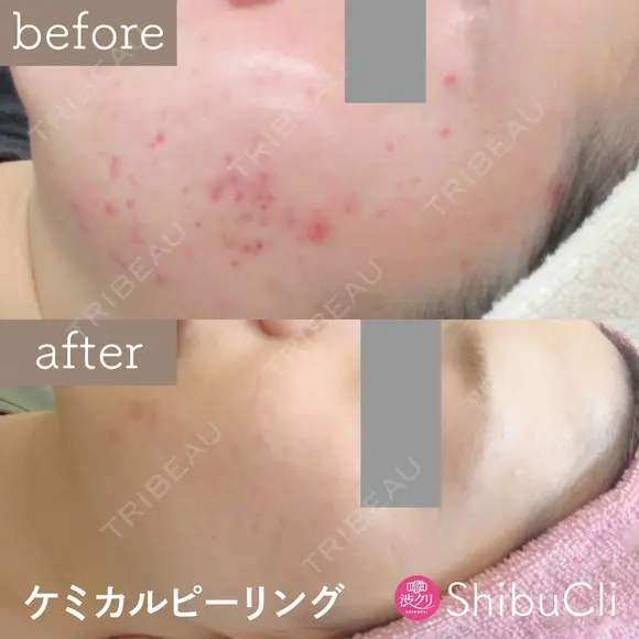ケミカルピーリング  before画像 メイン用