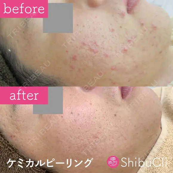 ケミカルピーリング  before画像 メイン用
