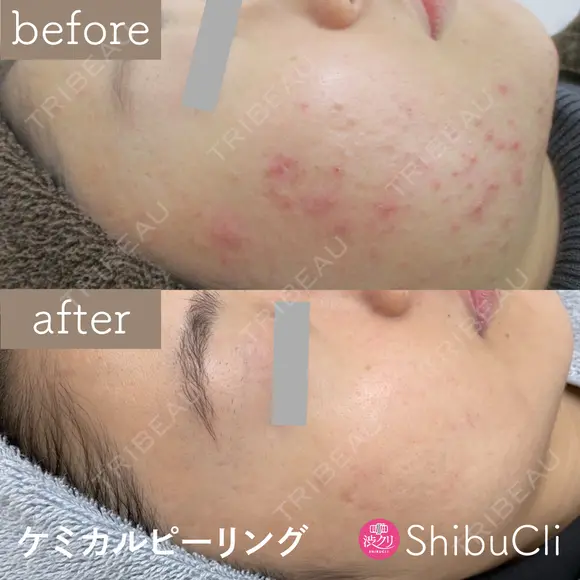 ケミカルピーリング  before画像 メイン用