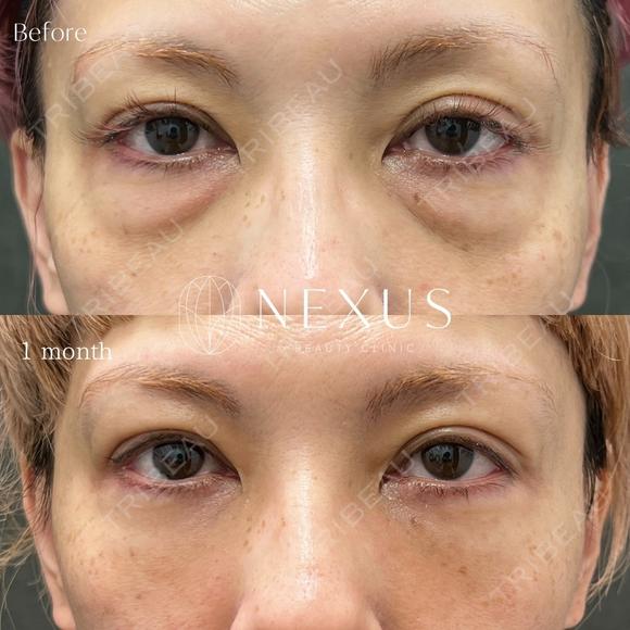 裏ハムラ法＋脂肪注入 after画像 メイン用