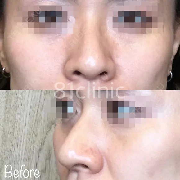鼻翼縮小(糸) before画像 メイン用