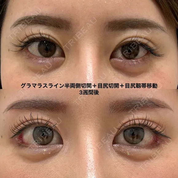 グラマラスライン半両側切開＋目尻切開＋目尻靱帯移動 before画像 メイン用
