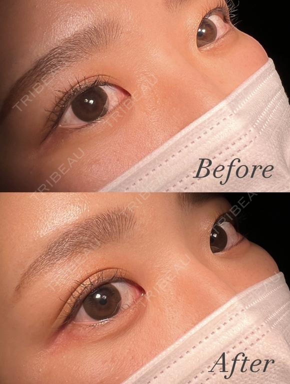 涙袋ヒアルロン酸 after画像 メイン用