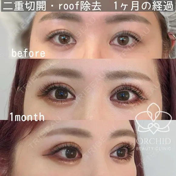 二重全切開フルコース・roof脂肪除去 before画像 メイン用