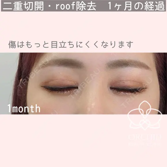 二重全切開フルコース・roof脂肪除去 30日後 メイン用