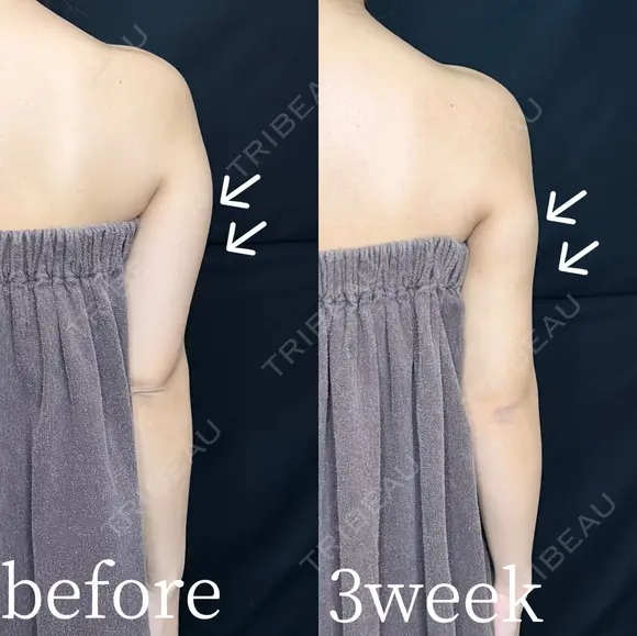二の腕・肩・セット　脂肪吸引 after画像 メイン用