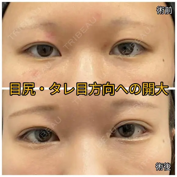 タレ目形成手術で癒し系の目元に💝 after画像 メイン用
