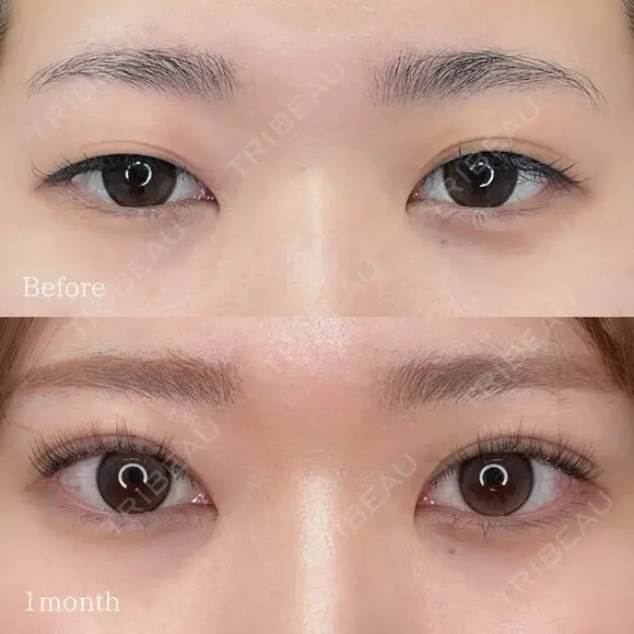二重埋没(クイックシンデレラ・トリプル) before画像 メイン用