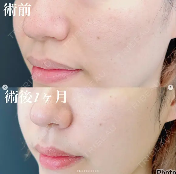脂肪注入(ほうれい線) after画像 メイン用