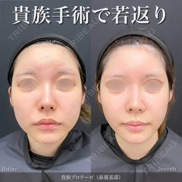 貴族手術(プロテーゼ) before画像 メイン用