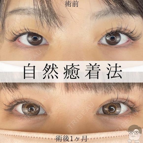 自然癒着法（エターナル二重術） after画像 メイン用
