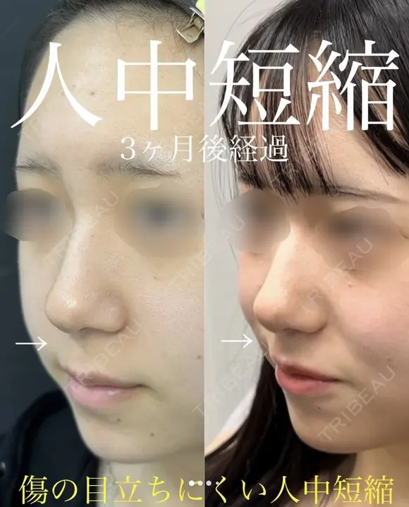 人中短縮 after画像 メイン用