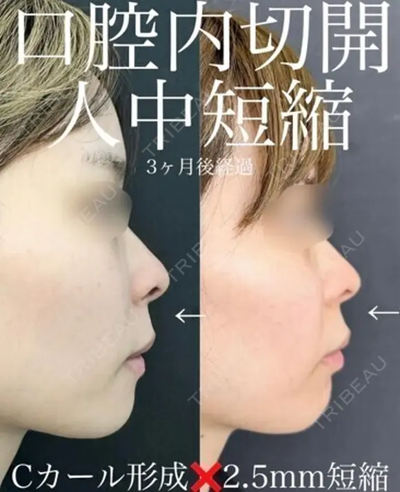 口腔内人中短縮 before画像 メイン用