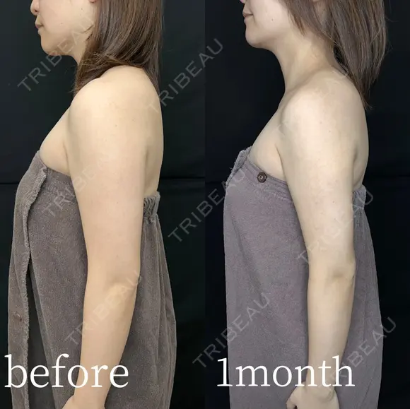 二の腕・肩・セット　脂肪吸引 before画像 メイン用
