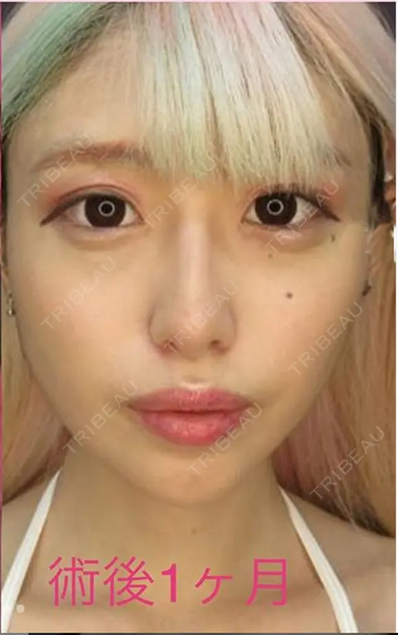 バッカルファット+ツヤ肌コラーゲンリフト after画像 メイン用