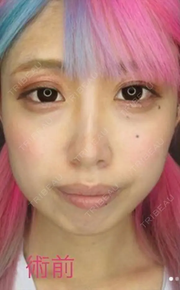バッカルファット+ツヤ肌コラーゲンリフト before画像 メイン用
