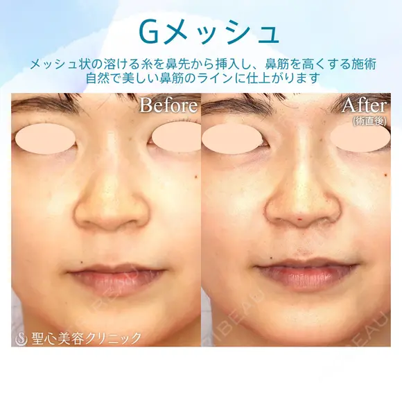 【30代女性・自然に鼻筋を整える】G-Mesh（Gメッシュ）による鼻形成（直後） 0日後 メイン用