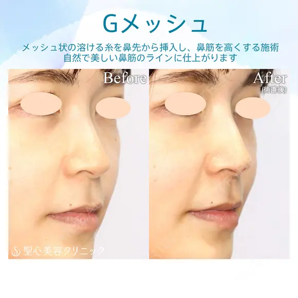 【30代女性・自然に鼻筋を整える】G-Mesh（Gメッシュ）による鼻形成（直後） 0日後 メイン用