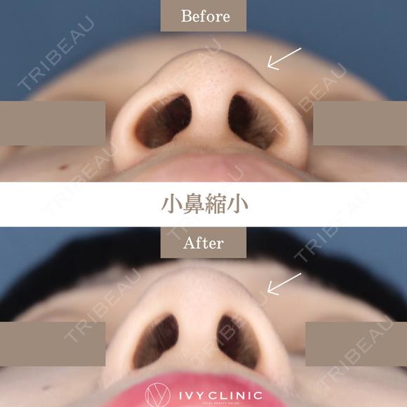 小鼻縮小 before画像 メイン用
