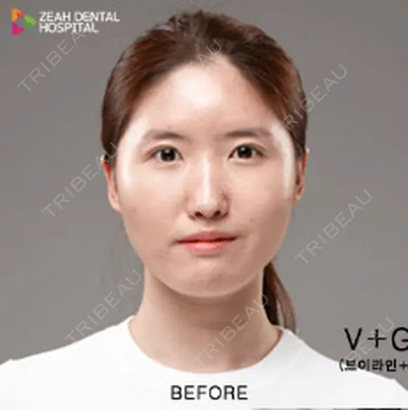 輪郭3点 before画像 メイン用