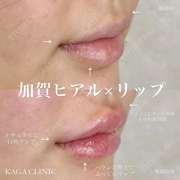 加賀ヒアル×リップ after画像 メイン用