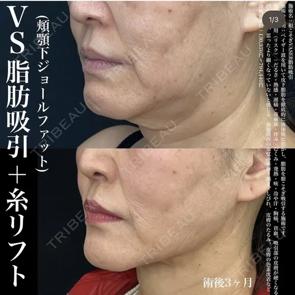 ベイザー脂肪吸引+糸リフト after画像 メイン用