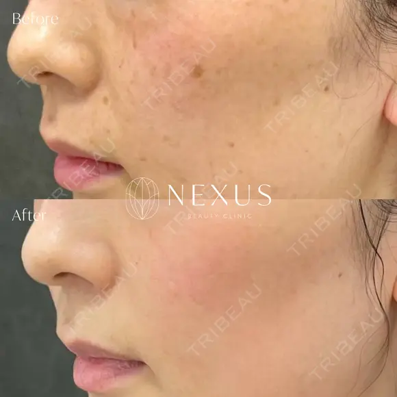 ピコスポット（シミ治療） before画像 メイン用