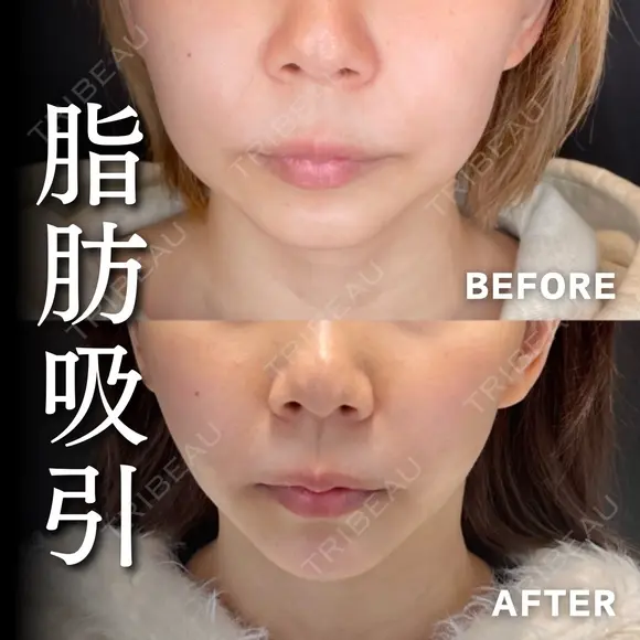 輪郭のもたつき解消😄顔の脂肪吸引 90日後 メイン用