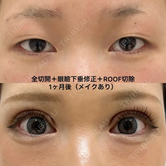 全切開＋眼瞼下垂修正＋ROOF切除 before画像 メイン用