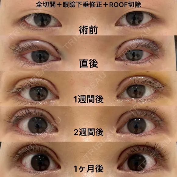 全切開＋眼瞼下垂修正＋ROOF切除 30日後 メイン用