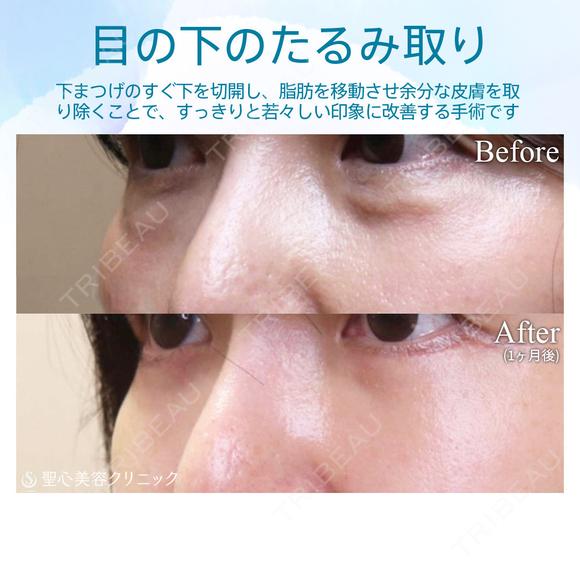 【40代女性・目の下のクマ・シワ・タルミ・膨らみ・凹みをスッキリ】ハムラ法（術後1ヶ月） after画像 メイン用