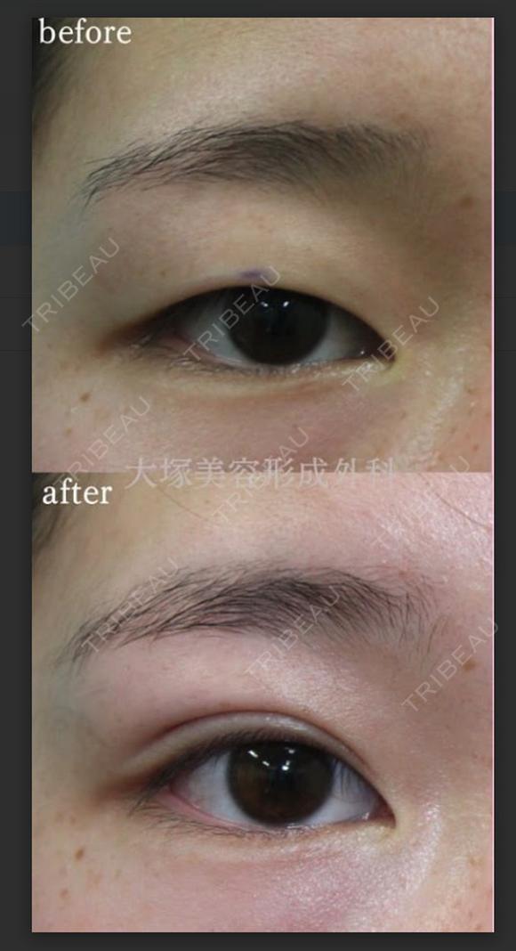 埋没法でくっきり二重に🥰 before画像 メイン用