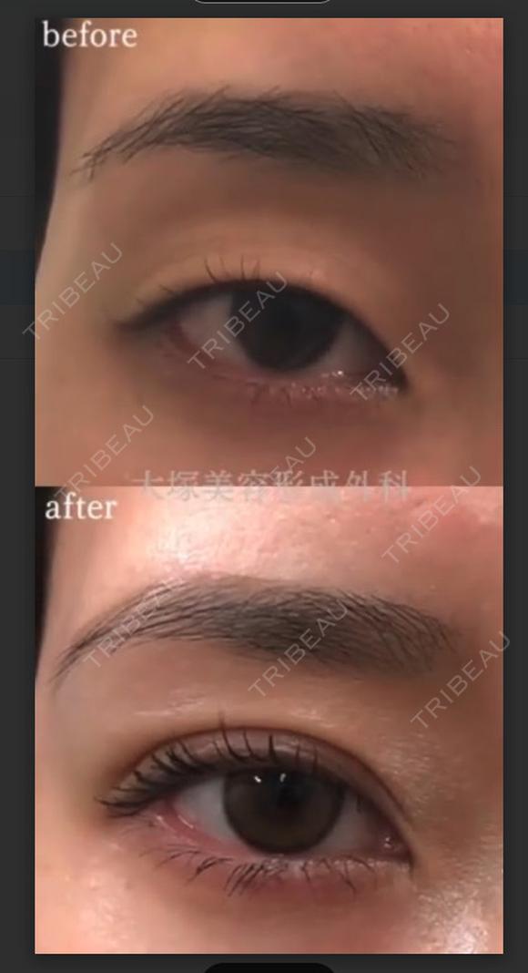 目元の印象アップ💞二重埋没 after画像 メイン用