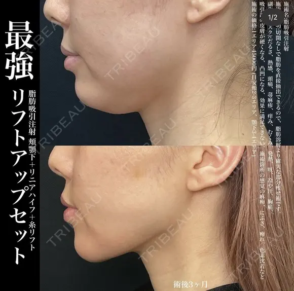脂肪吸引注射+リニアハイフ+糸リフト before画像 メイン用