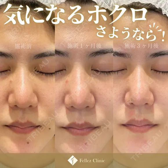 当院人気No1🌟ホクロ・イボ３個18,000円 after画像 メイン用