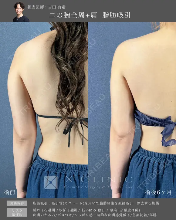 張り出し部分もまっすぐ綺麗に✨二の腕・肩脂肪吸引 after画像 メイン用