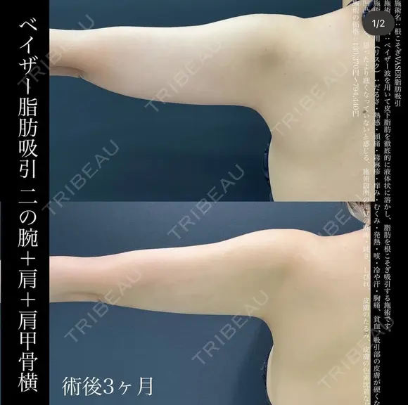 ベイザー脂肪吸引　二の腕+肩+肩甲骨横 after画像 メイン用