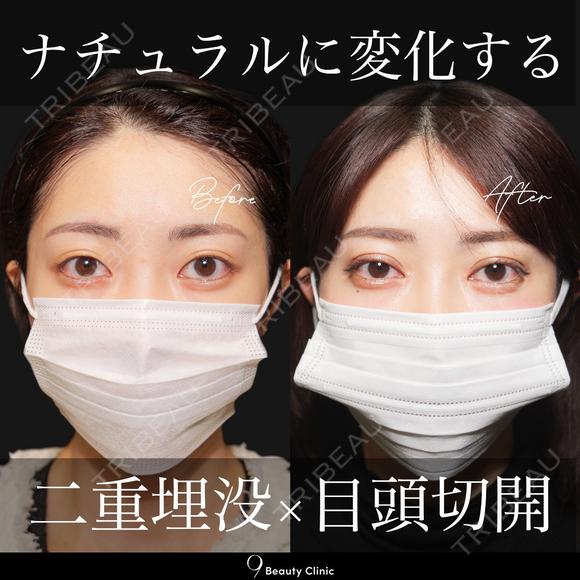 二重埋没・目頭切開 before画像 メイン用