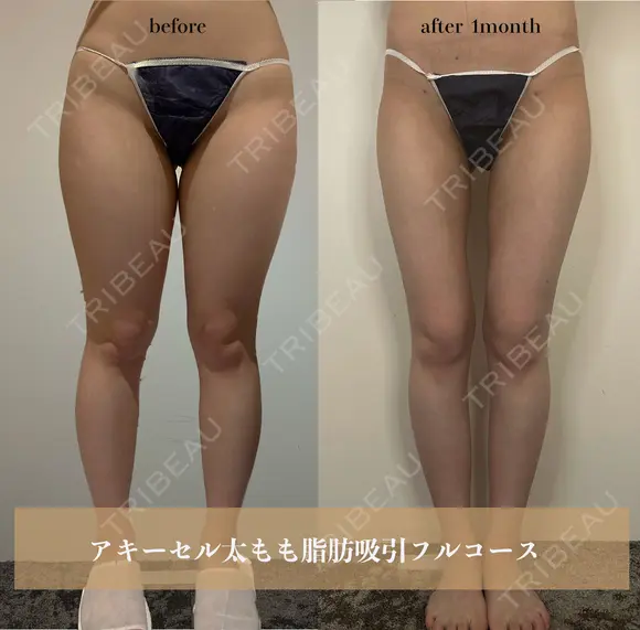 アキーセル太腿脂肪吸引 before画像 メイン用