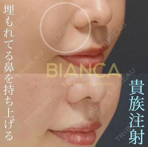 口元を整える😊ヒアルロン酸注入💉 after画像 メイン用