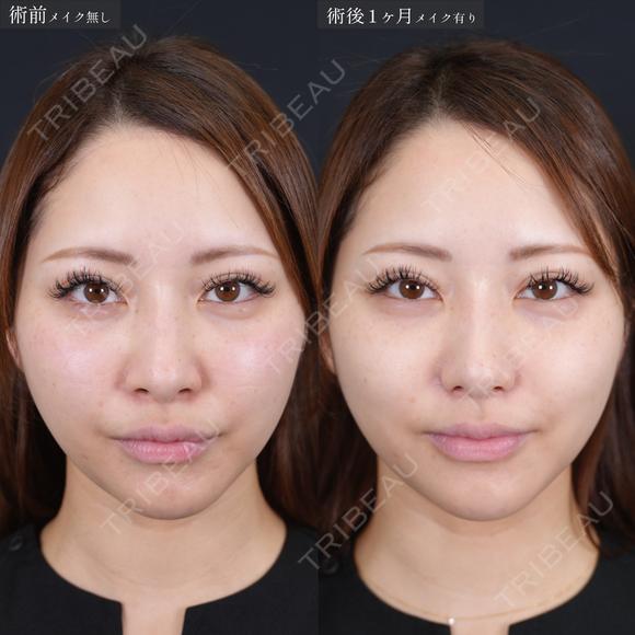 小鼻縮小 before画像 メイン用