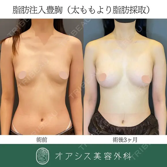 自然な仕上がりでバストアップ✨脂肪注入豊胸 90日後 メイン用