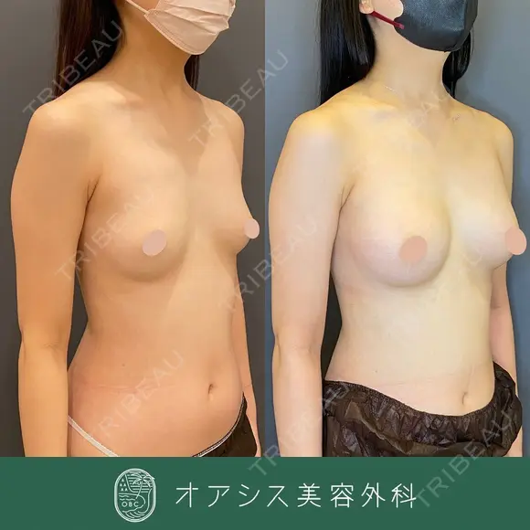 自然な仕上がりでバストアップ✨脂肪注入豊胸 90日後 メイン用