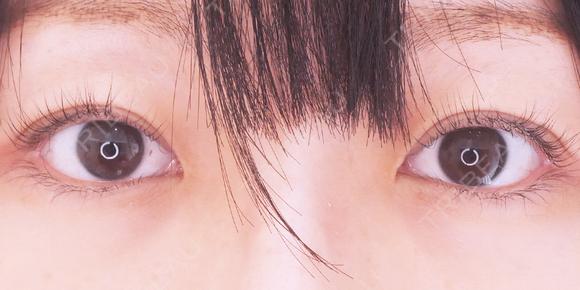 埋没法ダブル after画像 メイン用