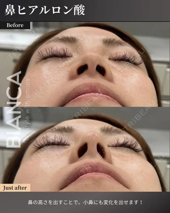 切らずに整える🌹鼻のヒアルロン酸注入💉 before画像 メイン用