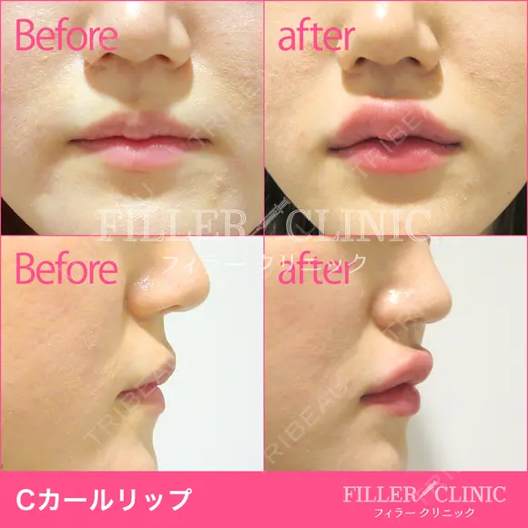Cカールリッ(スマイルリップ+人中短縮ヒアル) before画像 メイン用